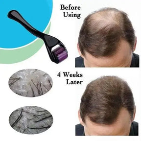 Natural Hair Regrowth | The Derma Roller for Hair Growth (0.5 mm) | Derma Roller for hair, beard and face